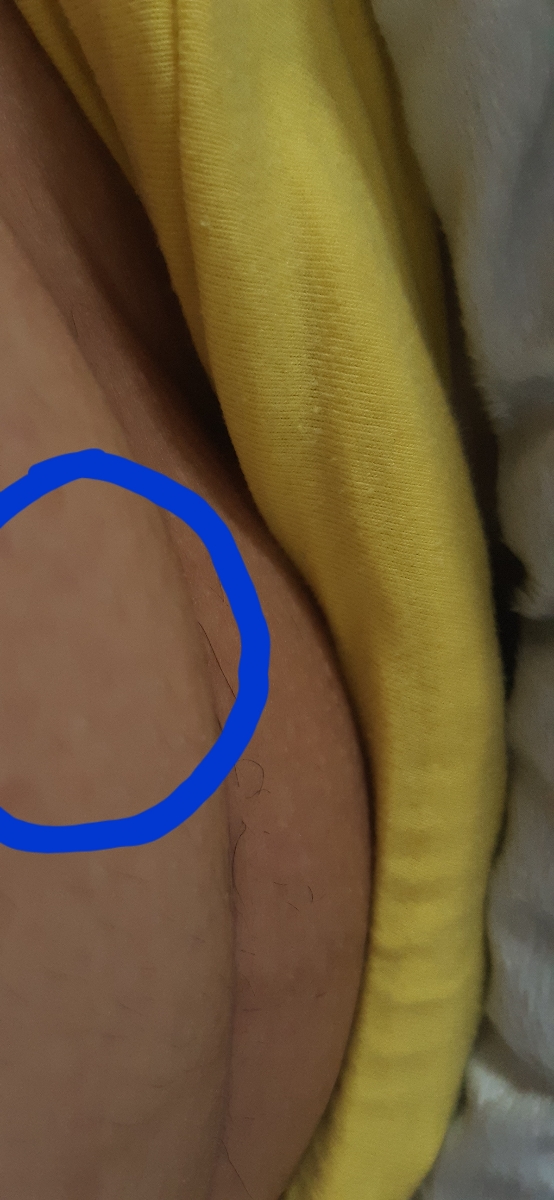 ورم و برآمدگی بالای خط سزارین