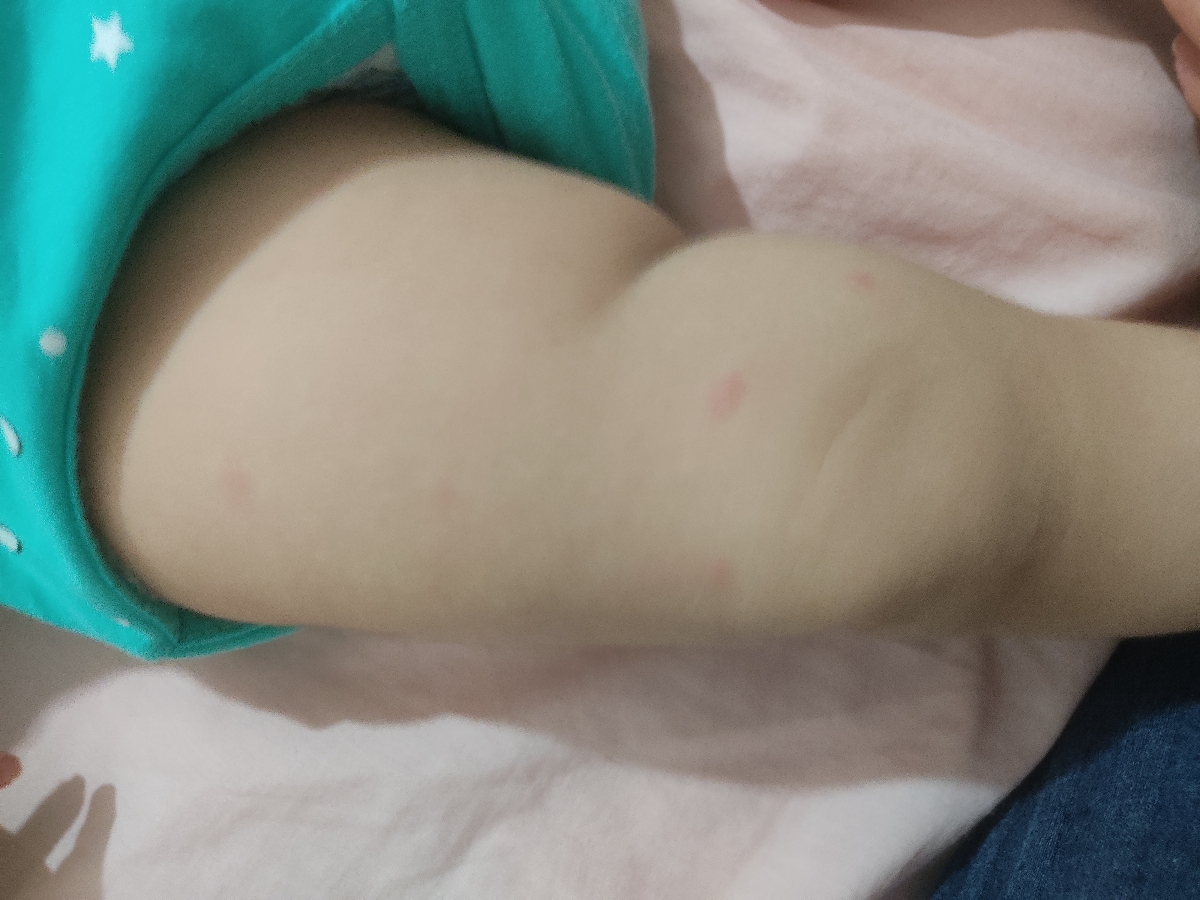 دونه های قرمز روی پای پسرم