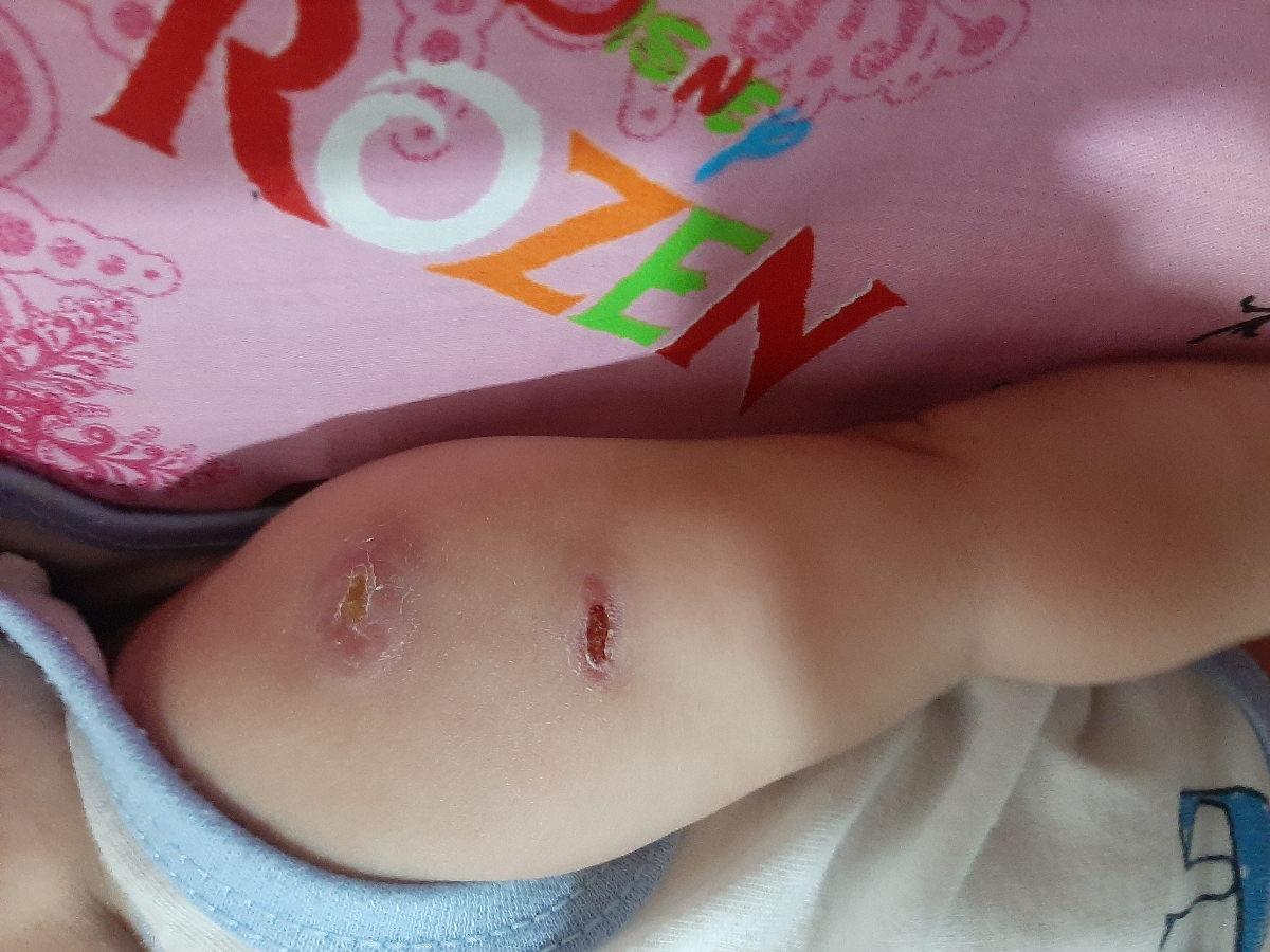 باد کردن جای واکسن نوزاد طبیعی است؟ باد کردن جای واکسن نوزاد طبیعی است؟