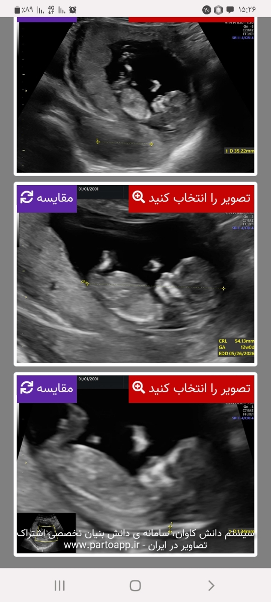 تفسیر سونو ان تی