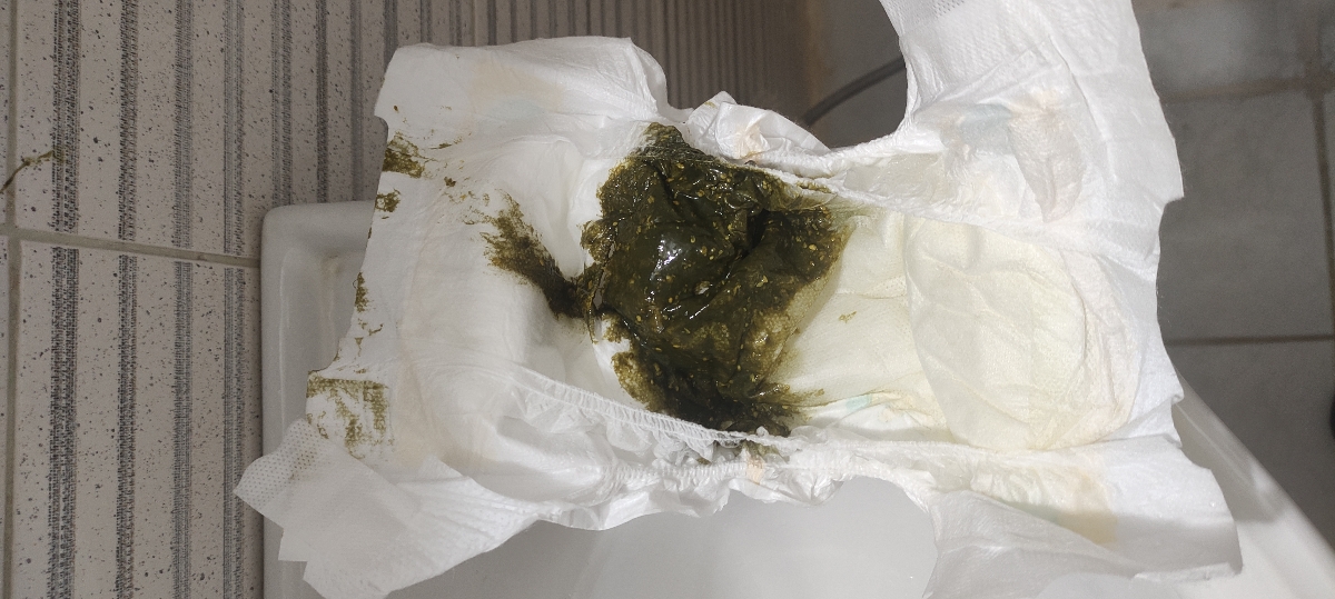 ❌مدفوع شل و سبز نوزاد ۵۳ روزه...❌ ❌مدفوع شل و سبز نوزاد ۵۳ روزه...❌