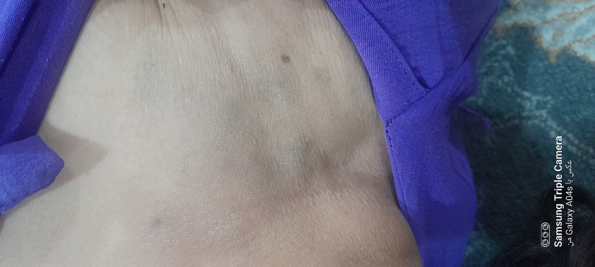 کبودی روی کتف و خشکی برای چیه قارچه؟؟؟؟؟؟ 🥲همراه عکس