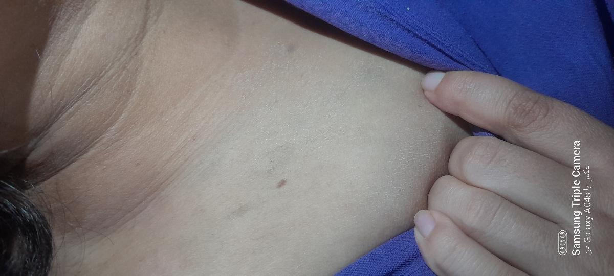 کبودی روی کتف و خشکی برای چیه قارچه؟؟؟؟؟؟ 🥲همراه عکس