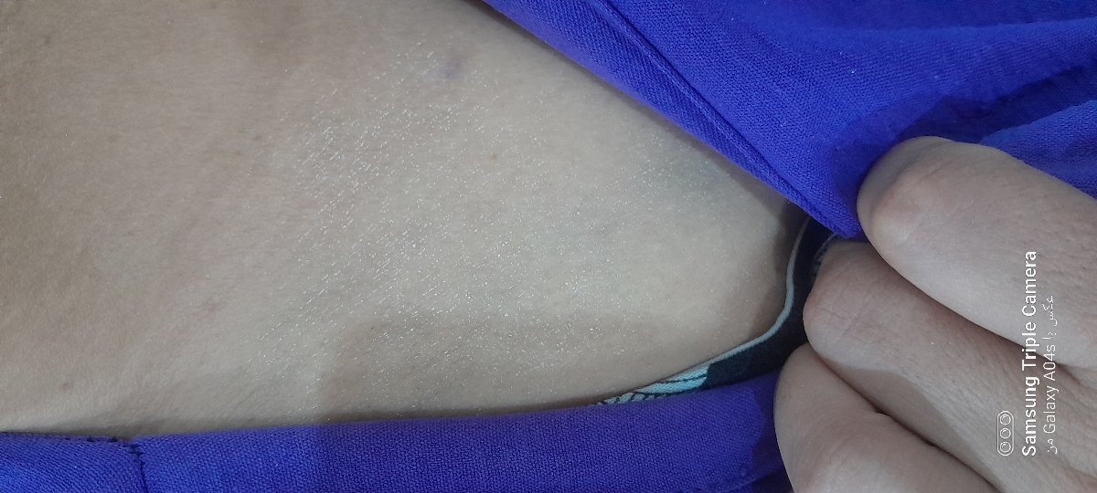 کبودی روی کتف و خشکی برای چیه قارچه؟؟؟؟؟؟ 🥲همراه عکس