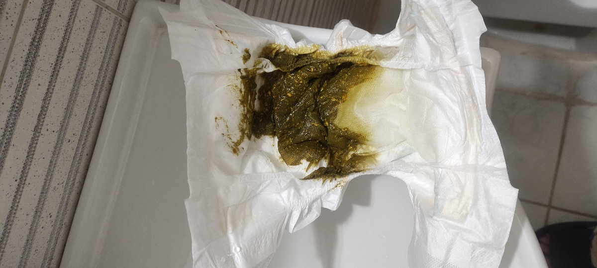 ❌مدفوع شل و سبز نوزاد ۵۳ روزه...❌ ❌مدفوع شل و سبز نوزاد ۵۳ روزه...❌