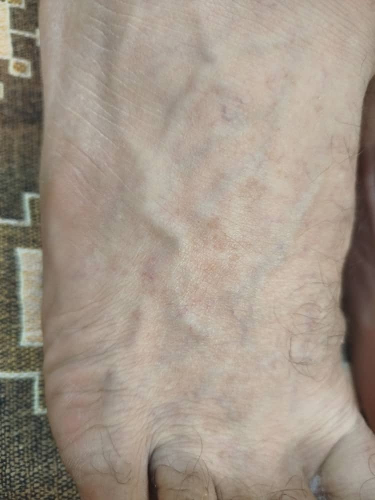 دکترجان آیا این واریسه ؟