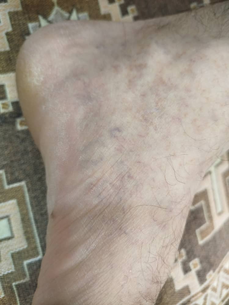 دکترجان آیا این واریسه ؟