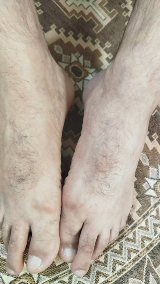 دکترجان آیا این واریسه ؟