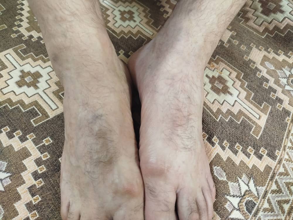 دکترجان آیا این واریسه ؟