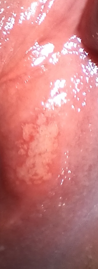 روی لابیا نزدیک  واژن 