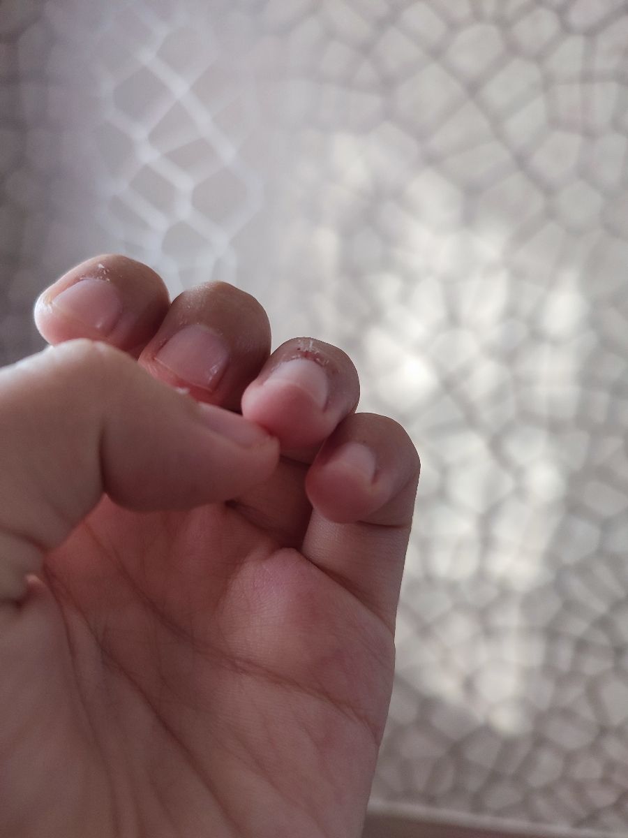 دکتر جان شاید بی ربط باشه ولی من پایین ناخنام اینجور شده همه انگشتام ، بعضیاشون درد هم دارن 😅 دست به دامن چت جی پی تی شدم گفت اینم میتونه یه نوع التهاب باشه 😂😅 خدا این چند هفته رو بخیر بگذرونه من که تو ۲۴ سالگی پیر شدم دیگه 🥲 دکتر جان شاید بی ربط باشه ولی من پایین ناخنام اینجور شده همه انگشتام ، بعضیاشون درد هم دارن 😅 دست به دامن چت جی پی تی شدم گفت اینم میتونه یه نوع التهاب باشه 😂😅 خدا این چند هفته رو بخیر بگذرونه من که تو ۲۴ سالگی پیر شدم دیگه 🥲