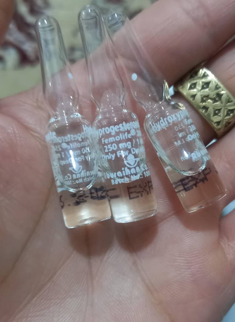 دوقلویی و هماتوم نسبتا زیاد