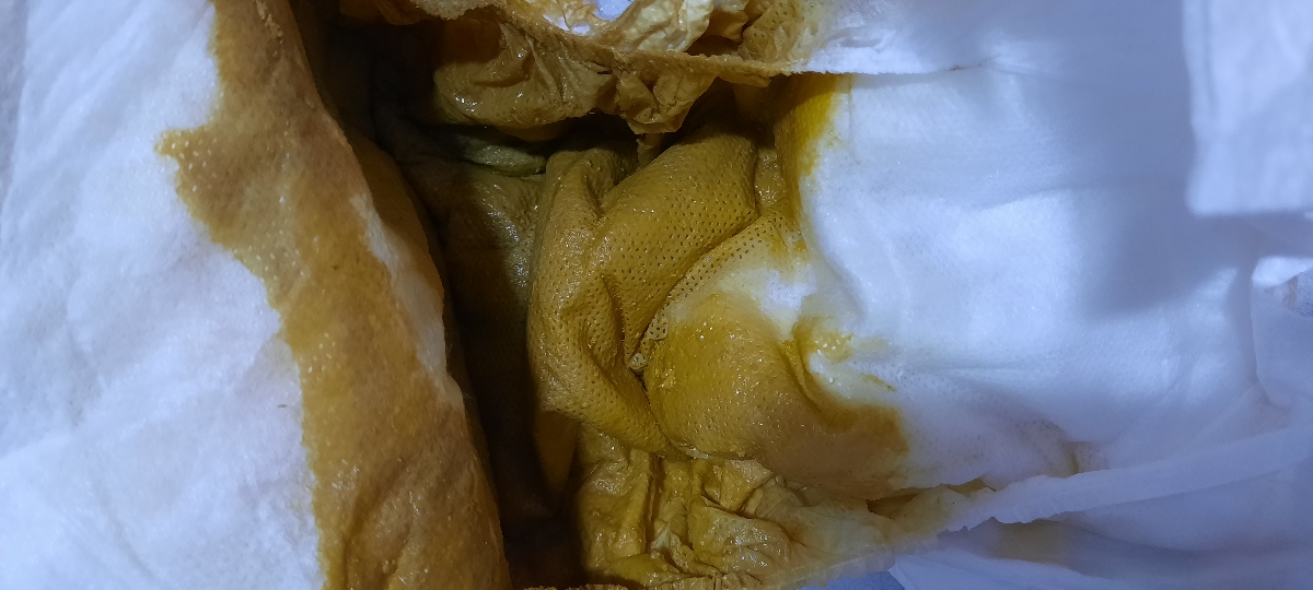 لکه نارنجی در پوشک