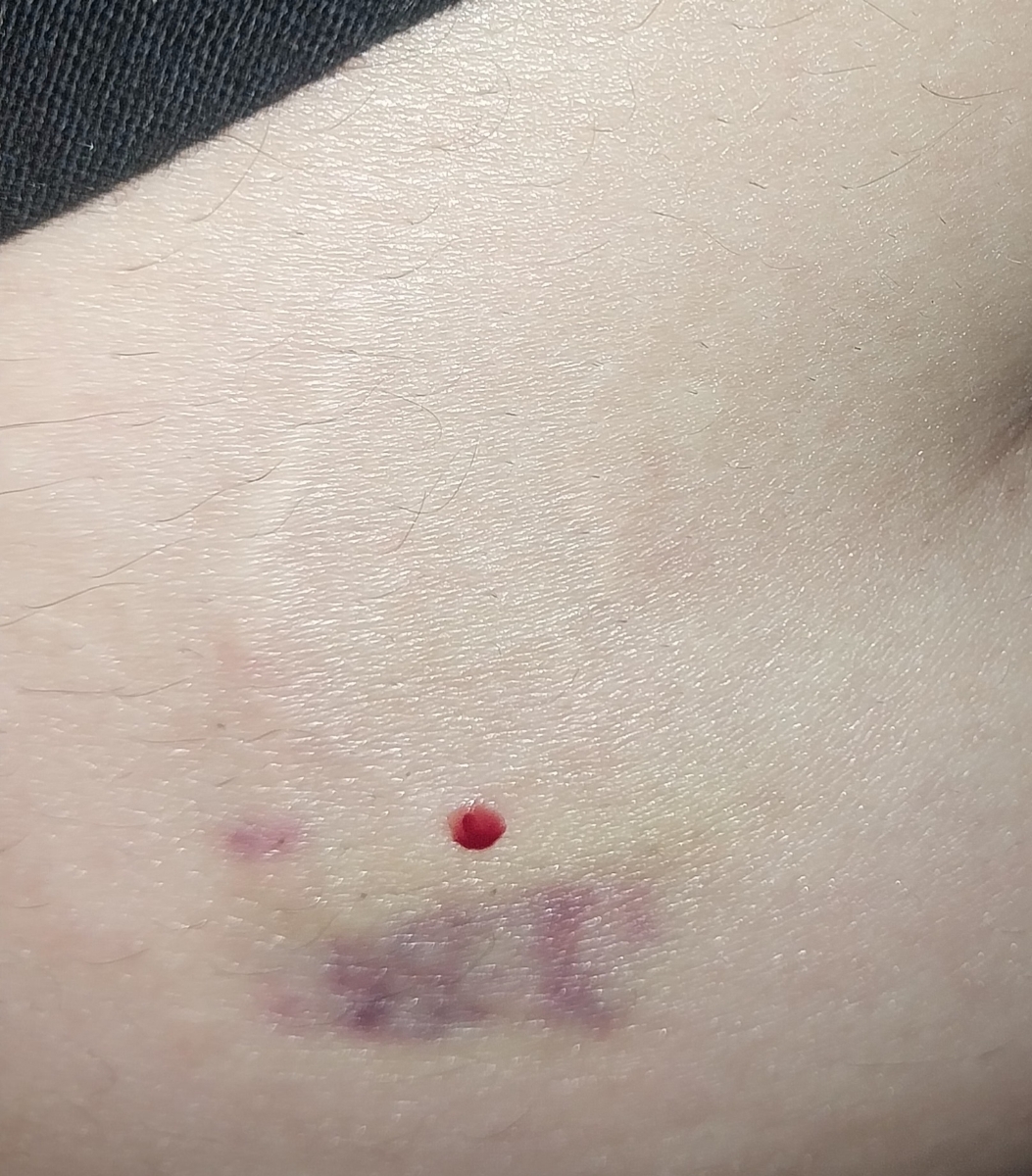 سلام بچها کسایی که انوکساپارین دور ناف میزنید میشه بیایین سلام بچها کسایی که انوکساپارین دور ناف میزنید میشه بیایین