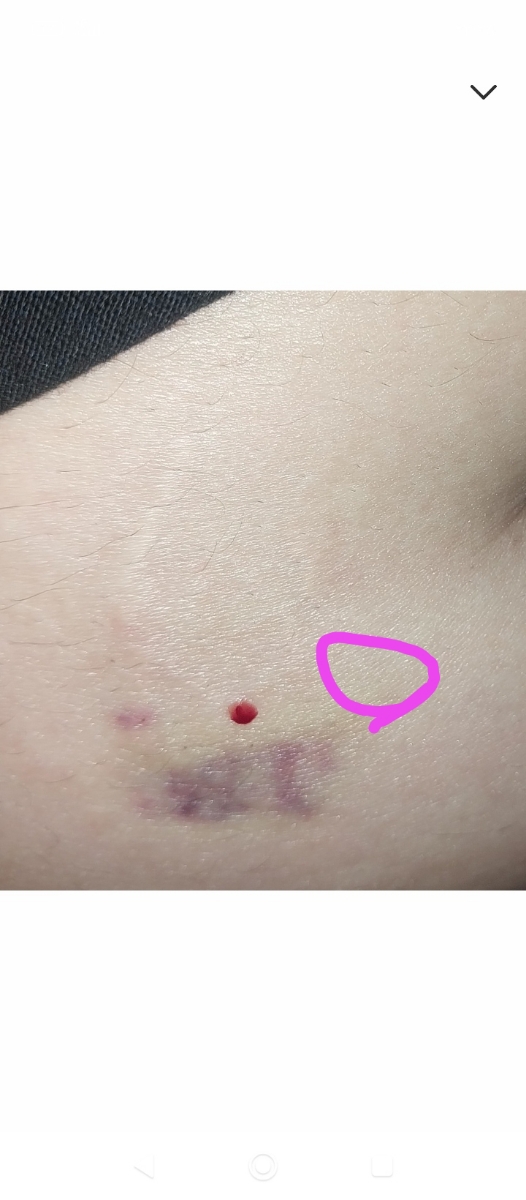 سریع بعدیش اینجا بزن یه نیشگون بگیر امپولو بزن وقتی خالی میکنی اروم اروم خالی کن بعدهم پد الکلی رو یکم اروم بزن روش دیگه فشار نده سریع بعدیش اینجا بزن یه نیشگون بگیر امپولو بزن وقتی خالی میکنی اروم اروم خالی کن بعدهم پد الکلی رو یکم اروم بزن روش دیگه فشار نده