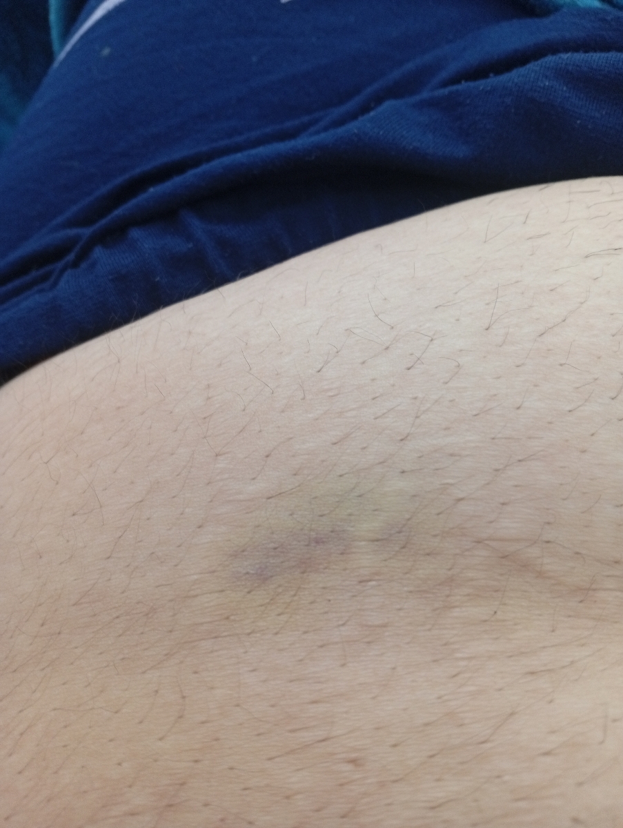 سلام بچها کسایی که انوکساپارین دور ناف میزنید میشه بیایین سلام بچها کسایی که انوکساپارین دور ناف میزنید میشه بیایین