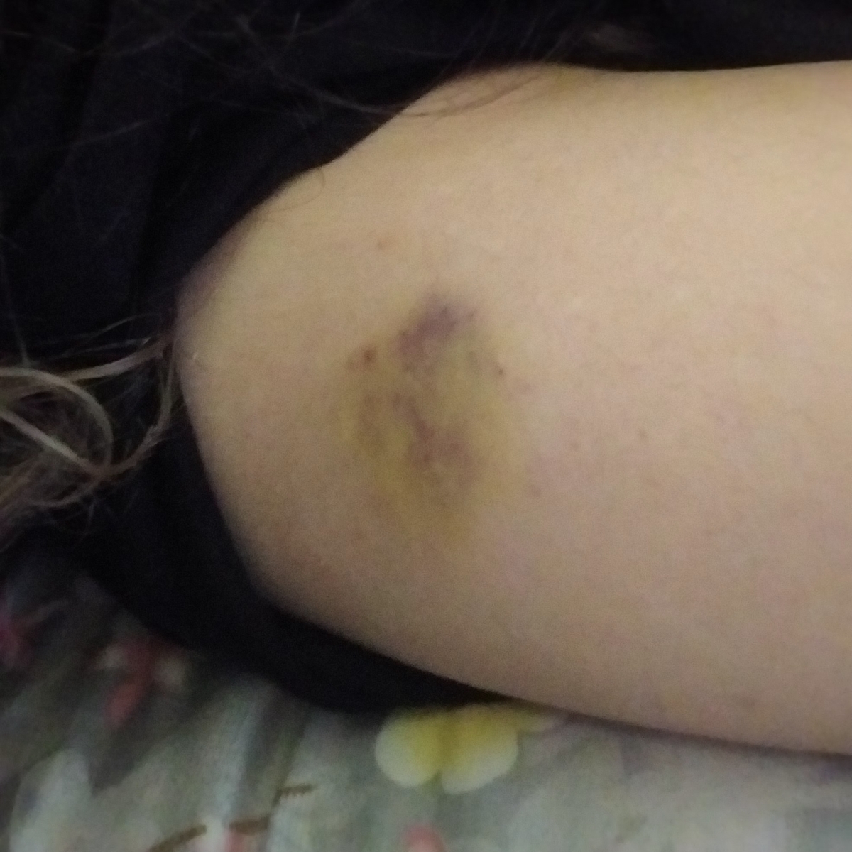 سلام بچها کسایی که انوکساپارین دور ناف میزنید میشه بیایین سلام بچها کسایی که انوکساپارین دور ناف میزنید میشه بیایین