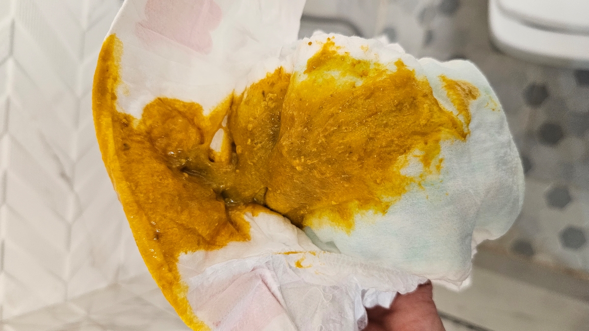 رفلاکس نوزاد یا حساسیت رفلاکس نوزاد یا حساسیت