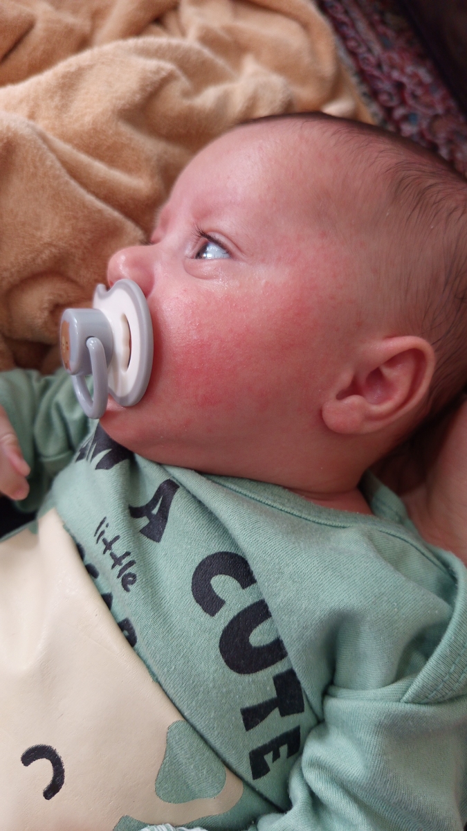 سلام خانم دکتر خوبین بچه من دو ماهشه صورتش دونه زده سلام خانم دکتر خوبین بچه من دو ماهشه صورتش دونه زده