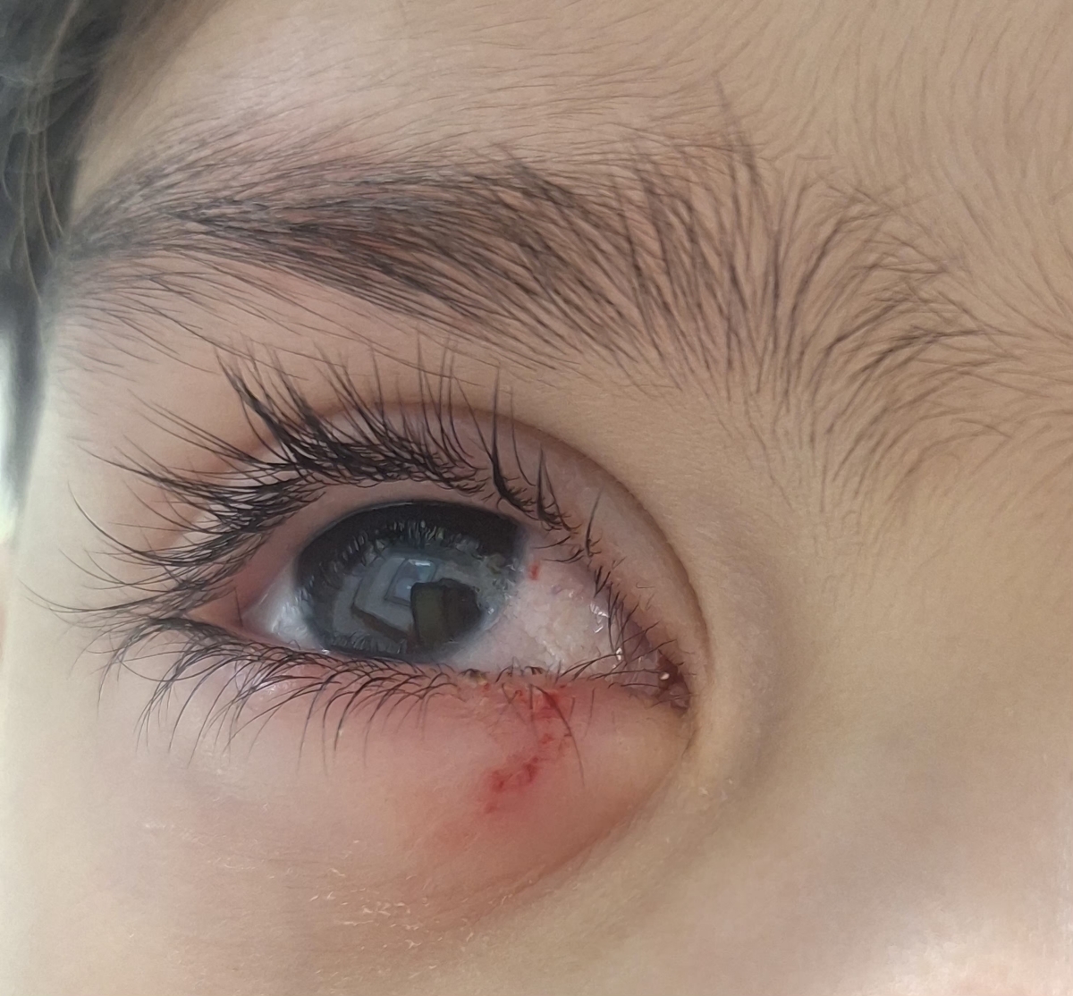 برخورد شی با چشم کودک