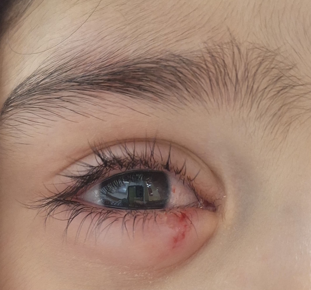 برخورد شی با چشم کودک