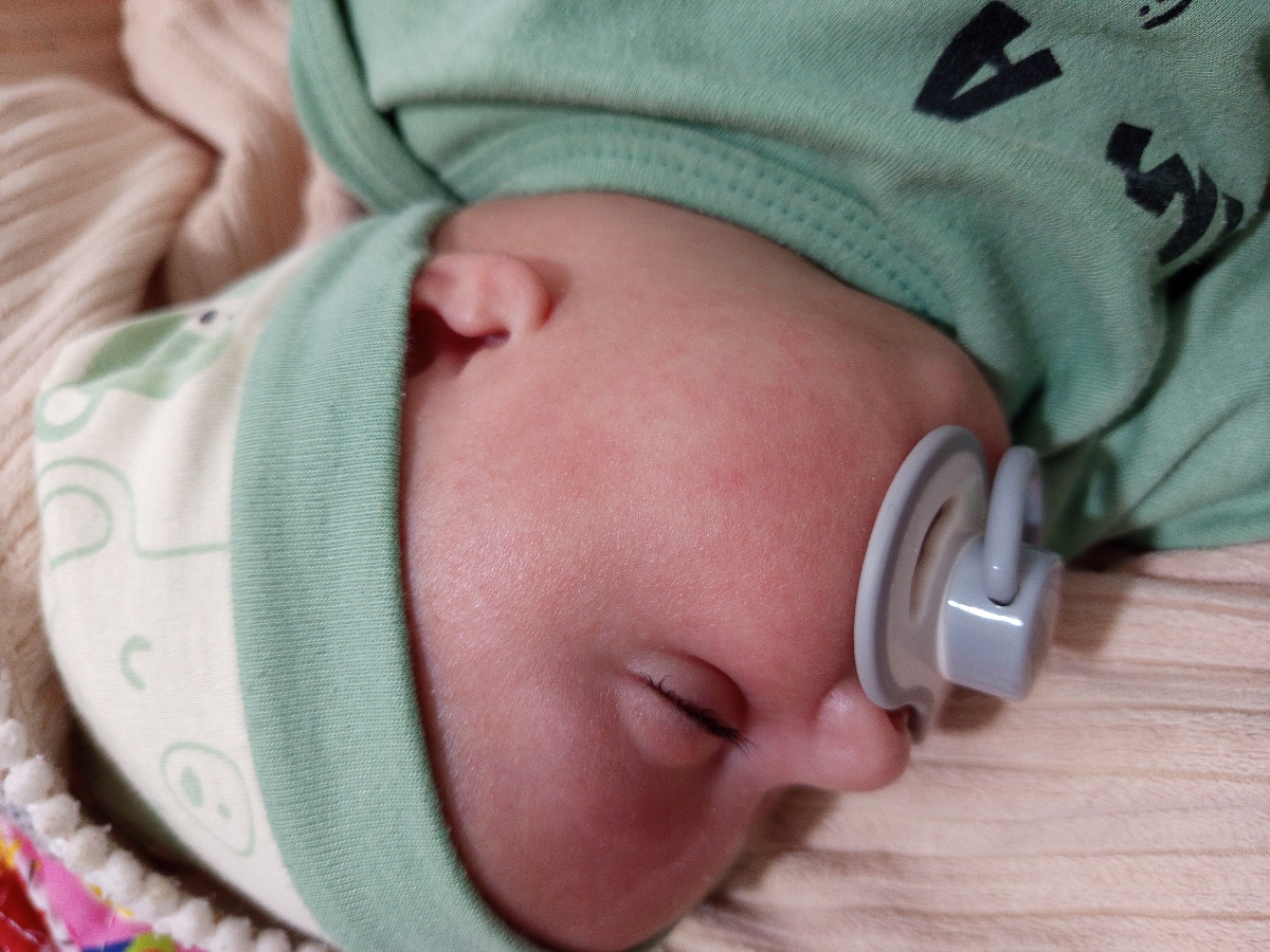 سلام خانم دکتر خوبین بچه من دو ماهشه صورتش دونه زده