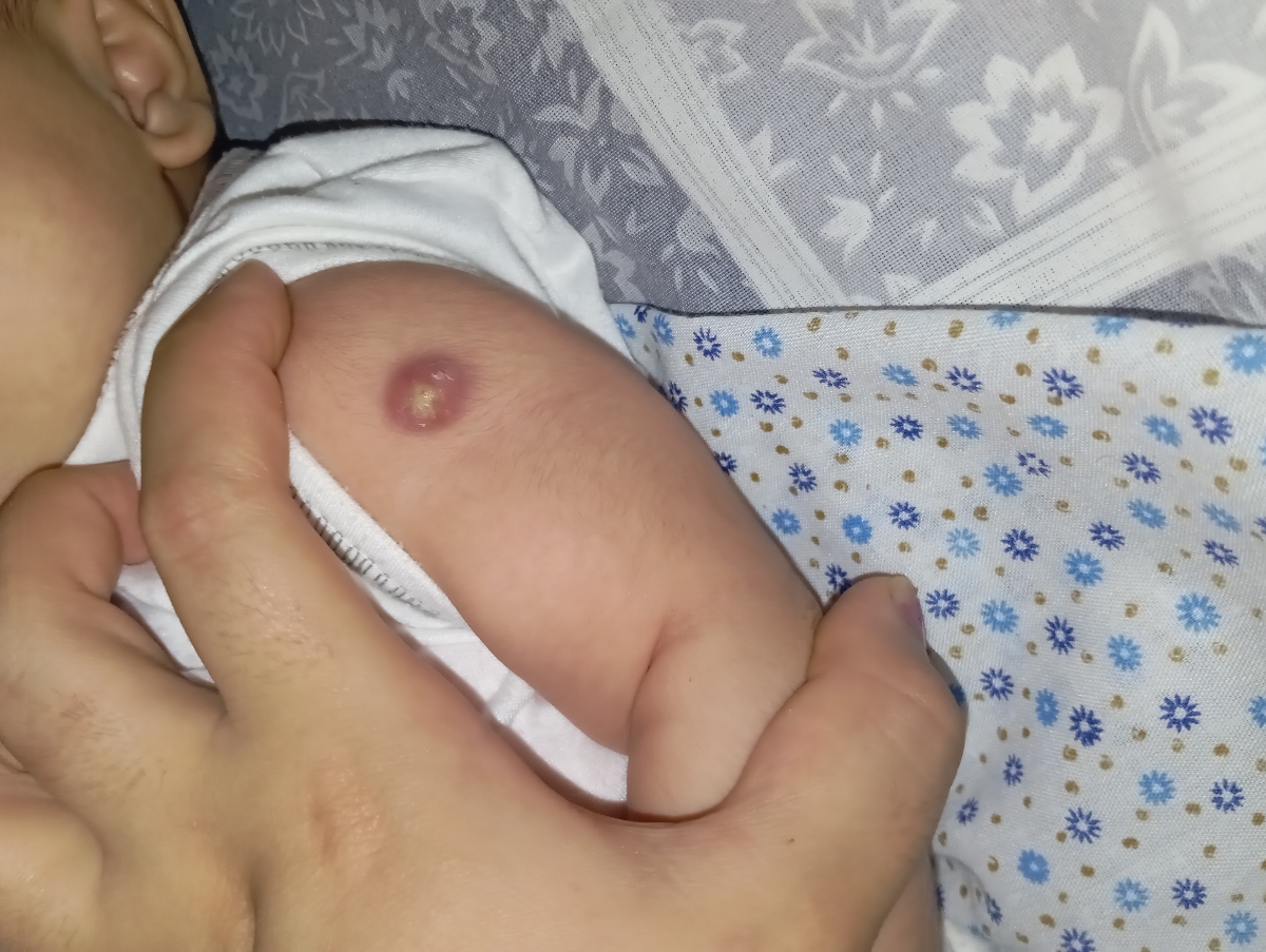 ورم جای واکسن بدو تولد ورم جای واکسن بدو تولد