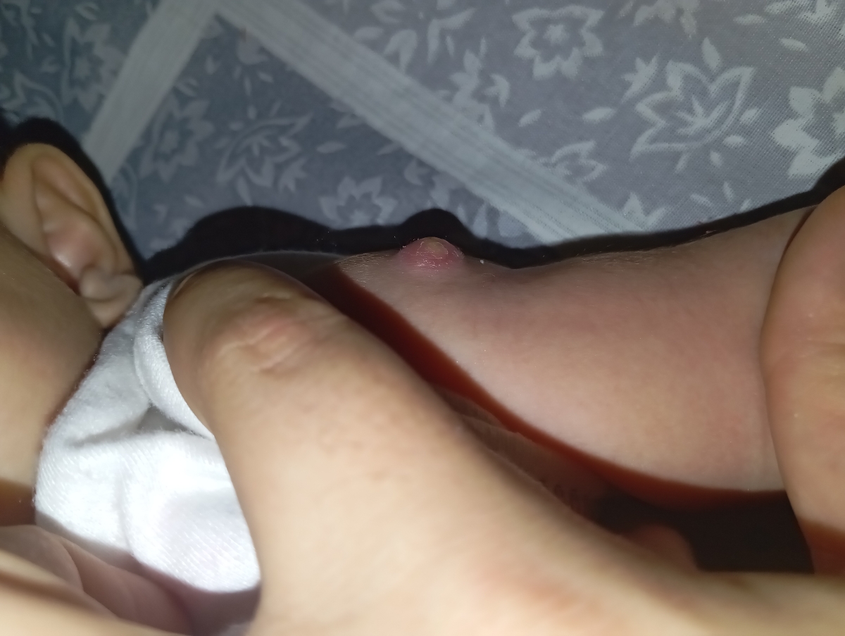 ورم جای واکسن بدو تولد ورم جای واکسن بدو تولد