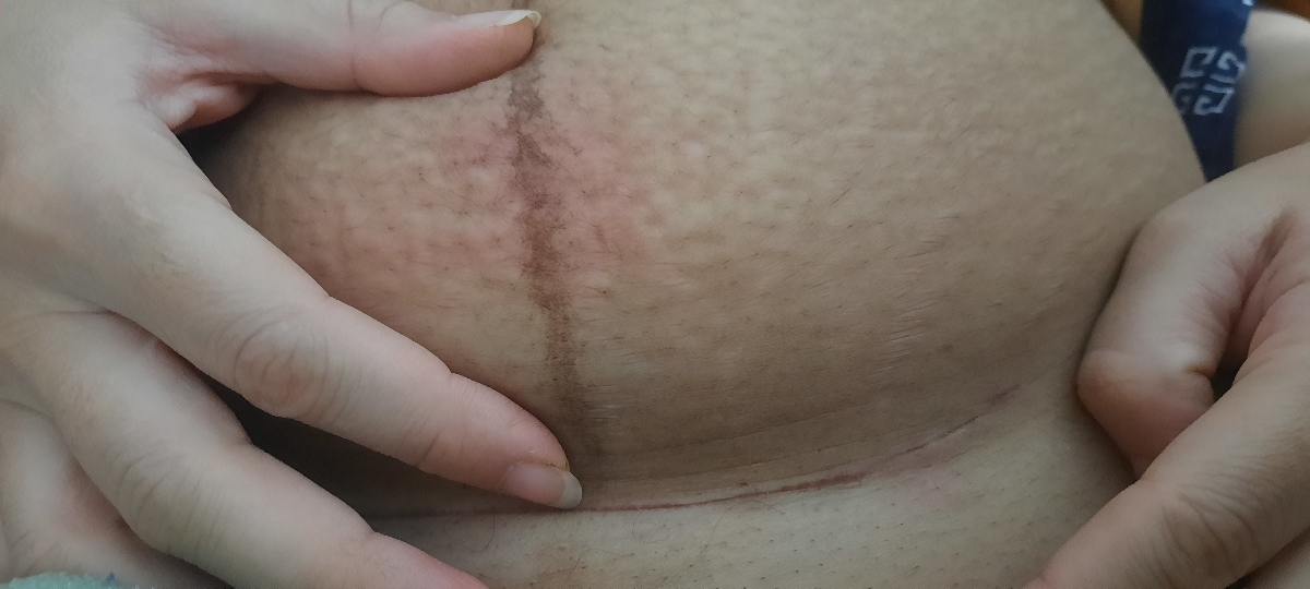 خط سزارین و برآمدگی زیر پوست خط سزارین و برآمدگی زیر پوست