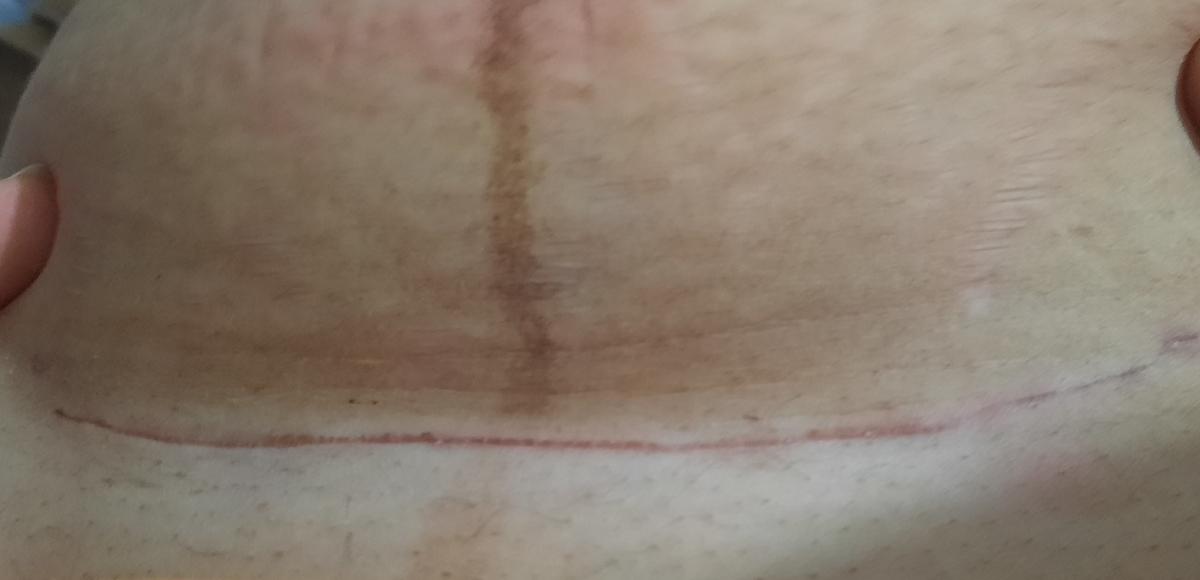 خانم دکتر خط سزارینم طبیعیه ؟انگار خطش مثل خون خشک شده اس خانم دکتر خط سزارینم طبیعیه ؟انگار خطش مثل خون خشک شده اس