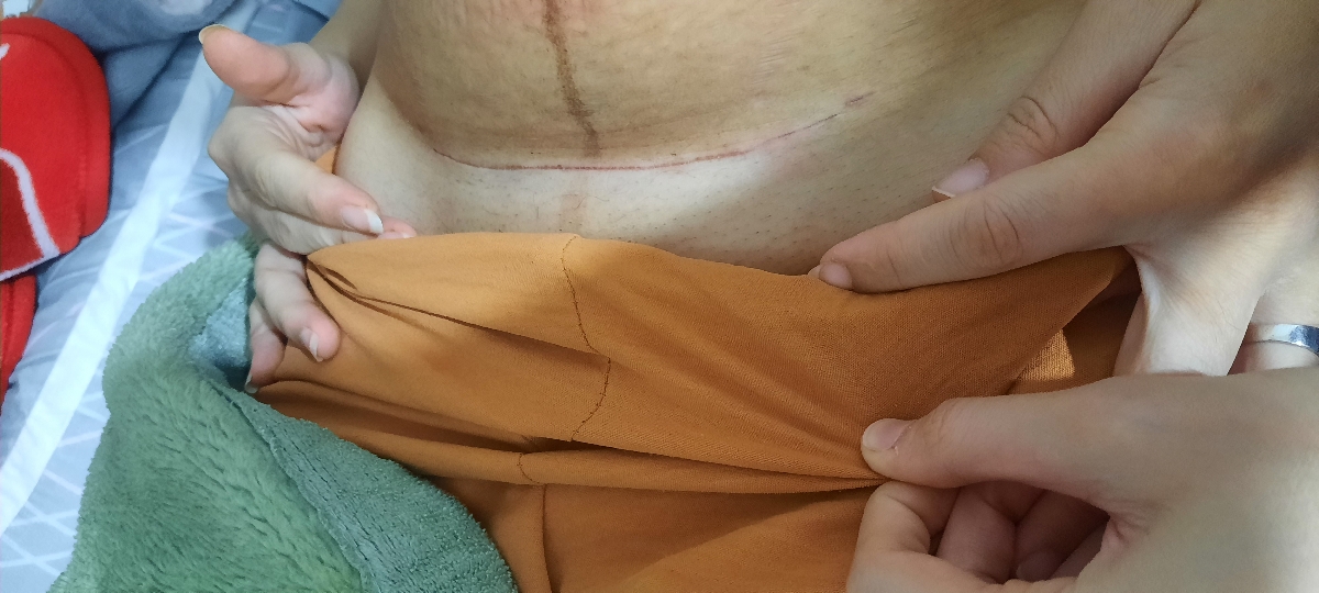 خط سزارین و برآمدگی زیر پوست خط سزارین و برآمدگی زیر پوست