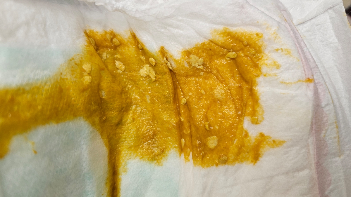 دانه های سفید داخل مدفوع دانه های سفید داخل مدفوع