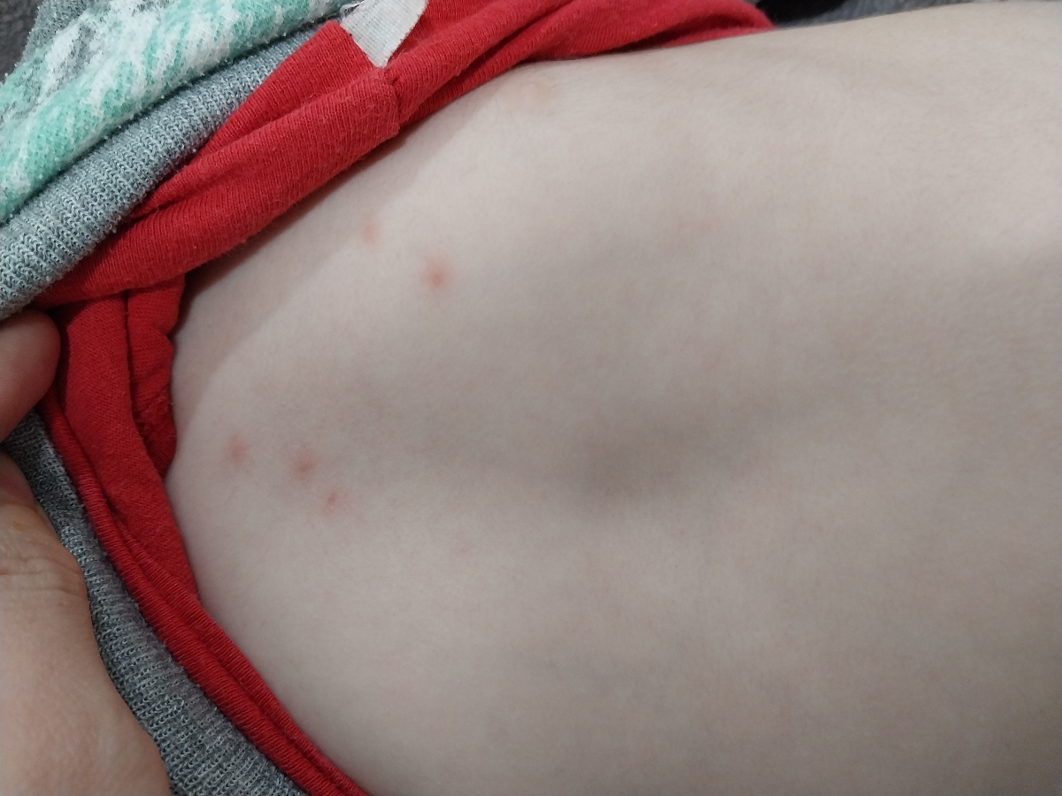 جوش های روی بدن