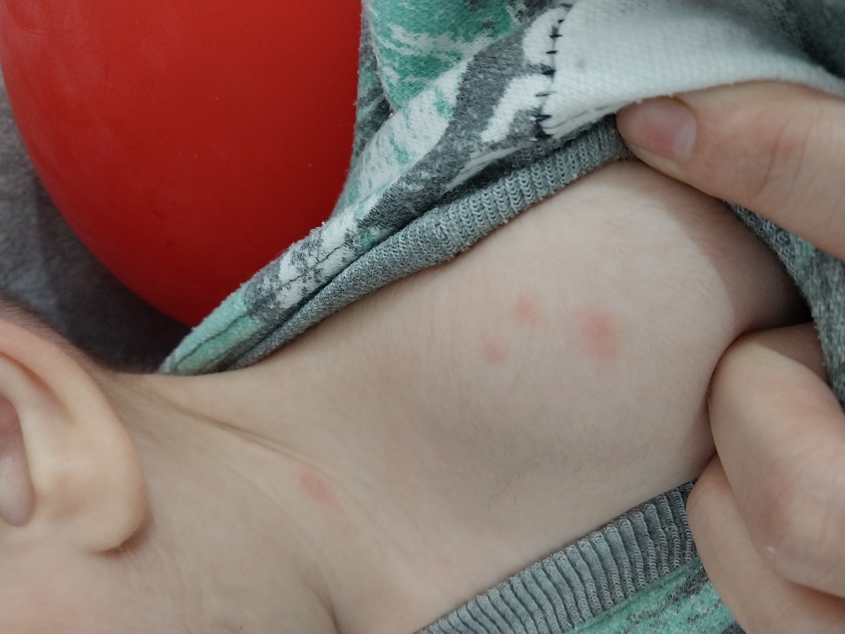 جوش های روی بدن