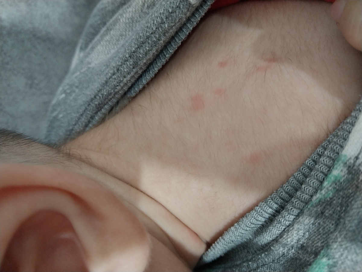 جوش های روی بدن