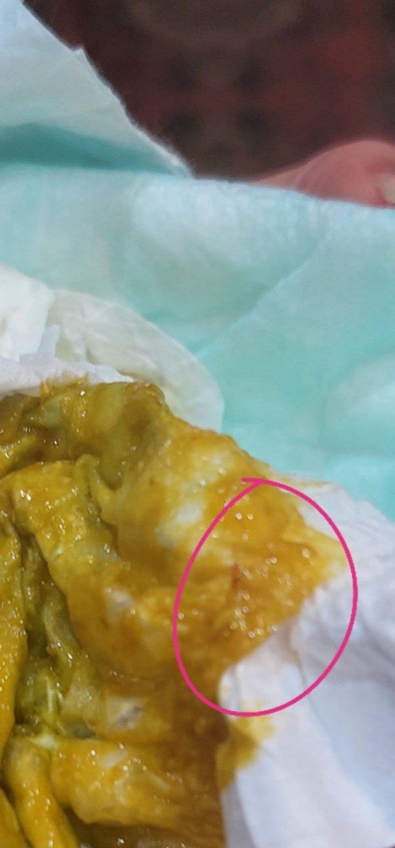 رگه های خونی در مدفوع نوزاد