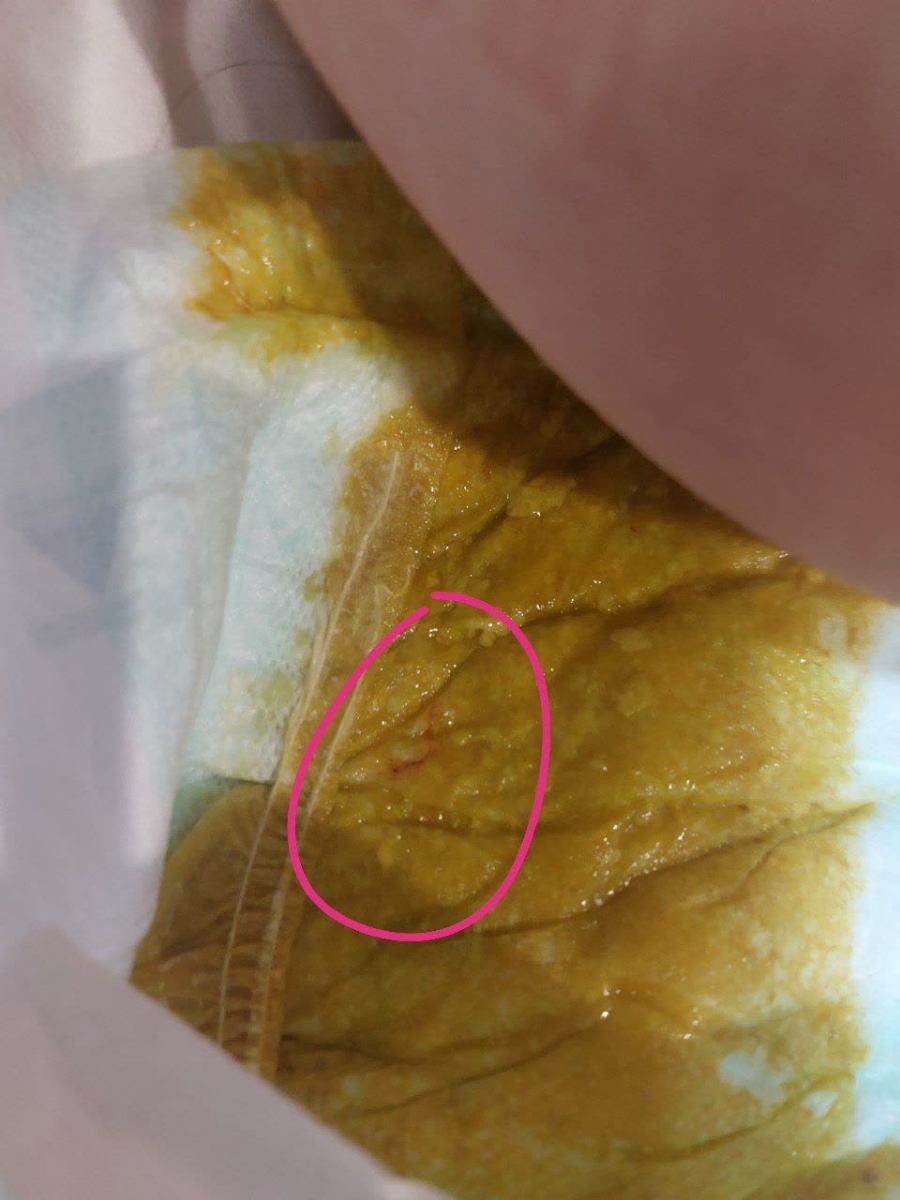 رگه های خونی در مدفوع نوزاد