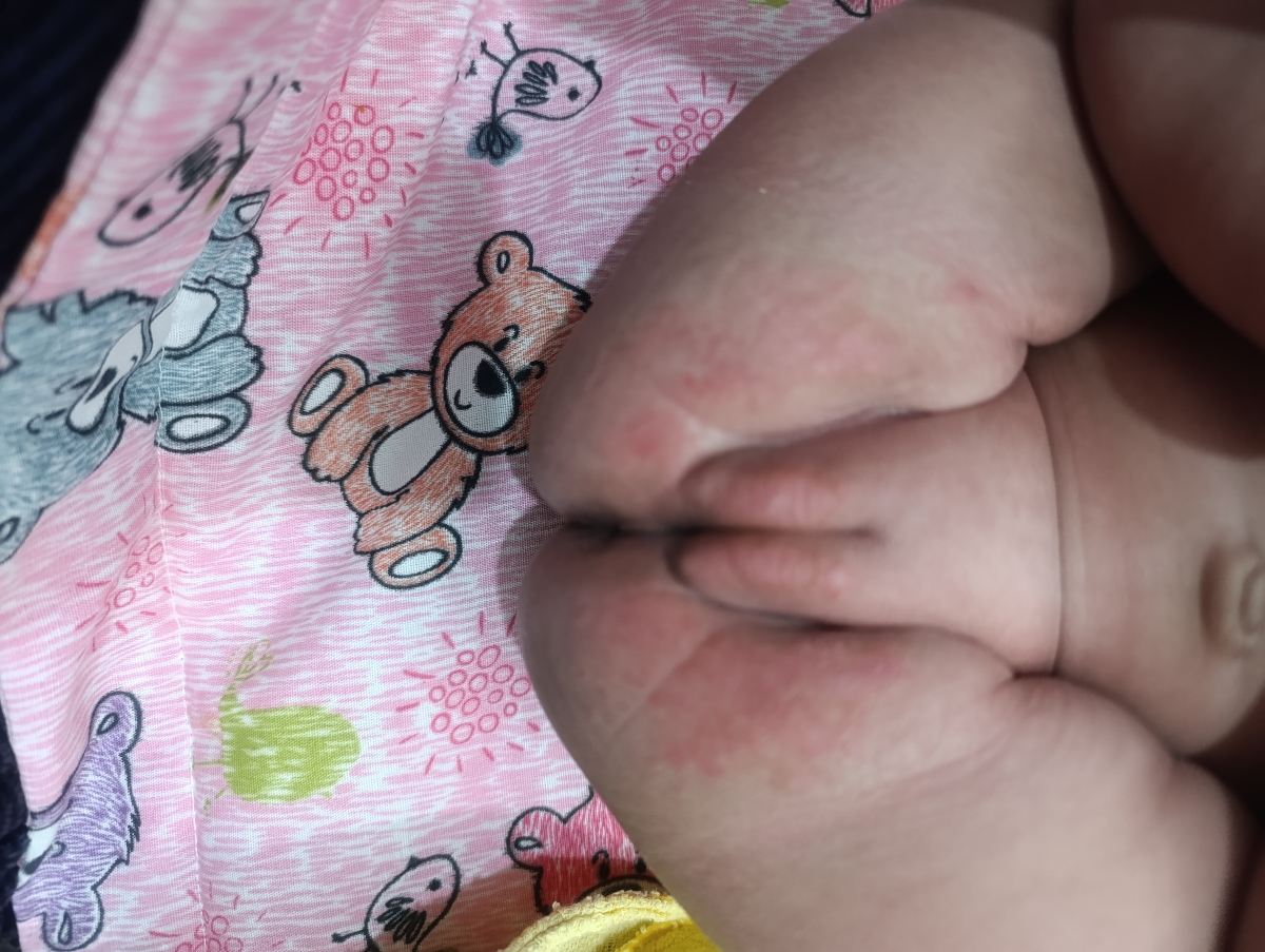 سوختن پای نوزاد