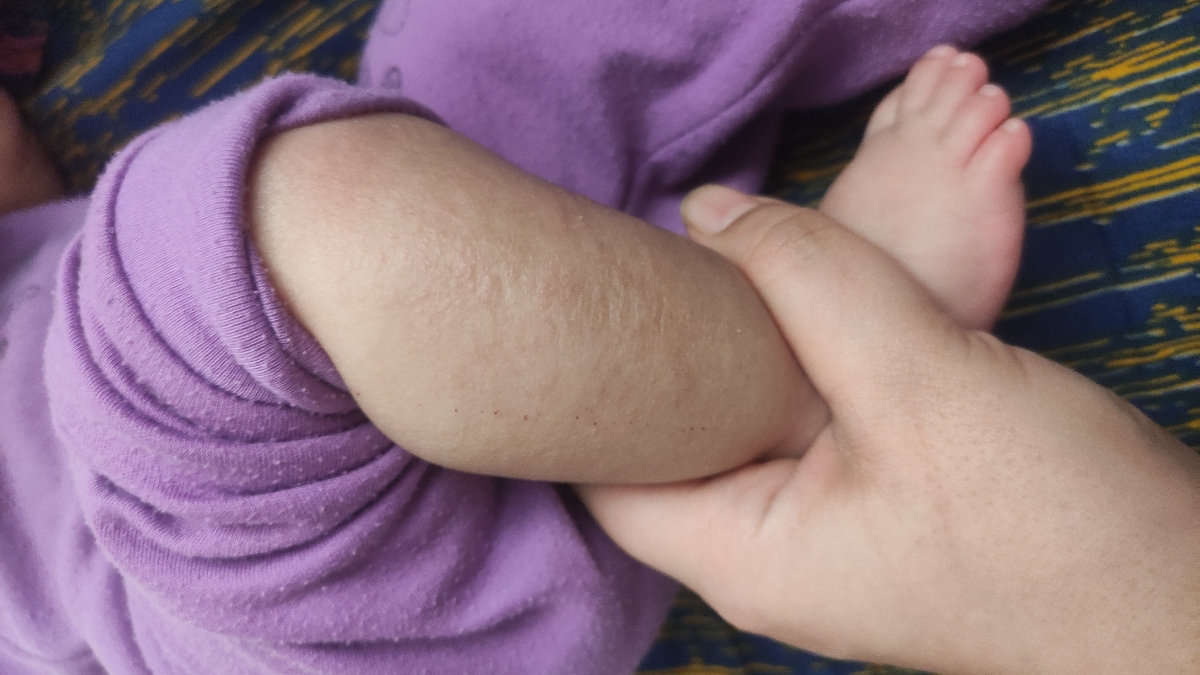 اگزما و آلرژی اگزما و آلرژی