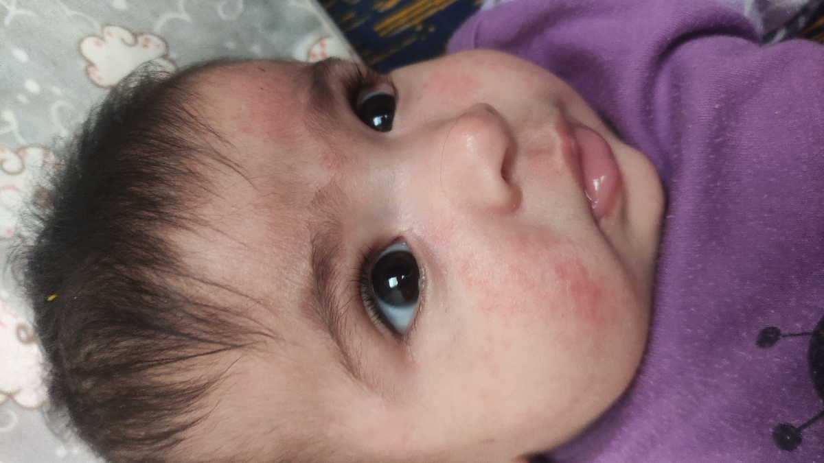 اگزما و آلرژی اگزما و آلرژی