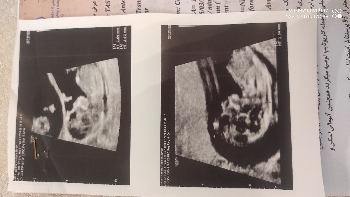 سلام خانم دکتر لطفاً بهم بگید nt قل اول من مشکوک هست؟