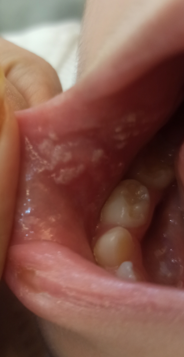 دونه های سفید چی هست