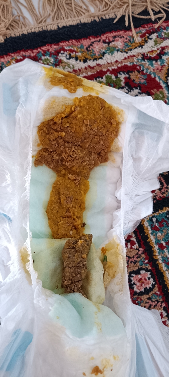 تغییر رنگ مدفوع کودک تغییر رنگ مدفوع کودک