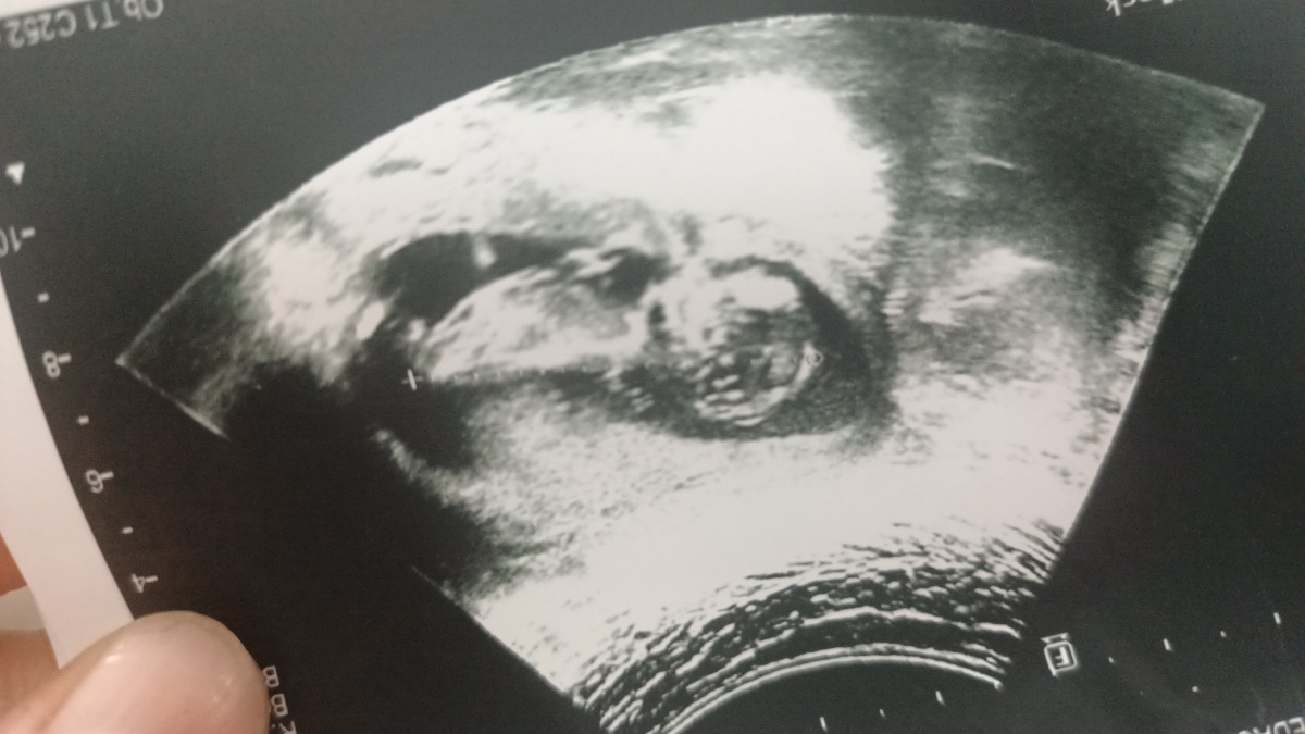 تشخیص جنسیت از روی سونو ان تی