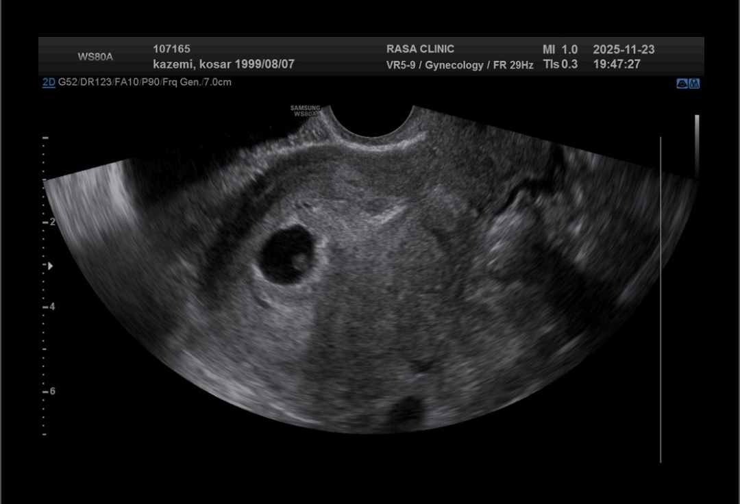 سونو قلب ۶ هفته