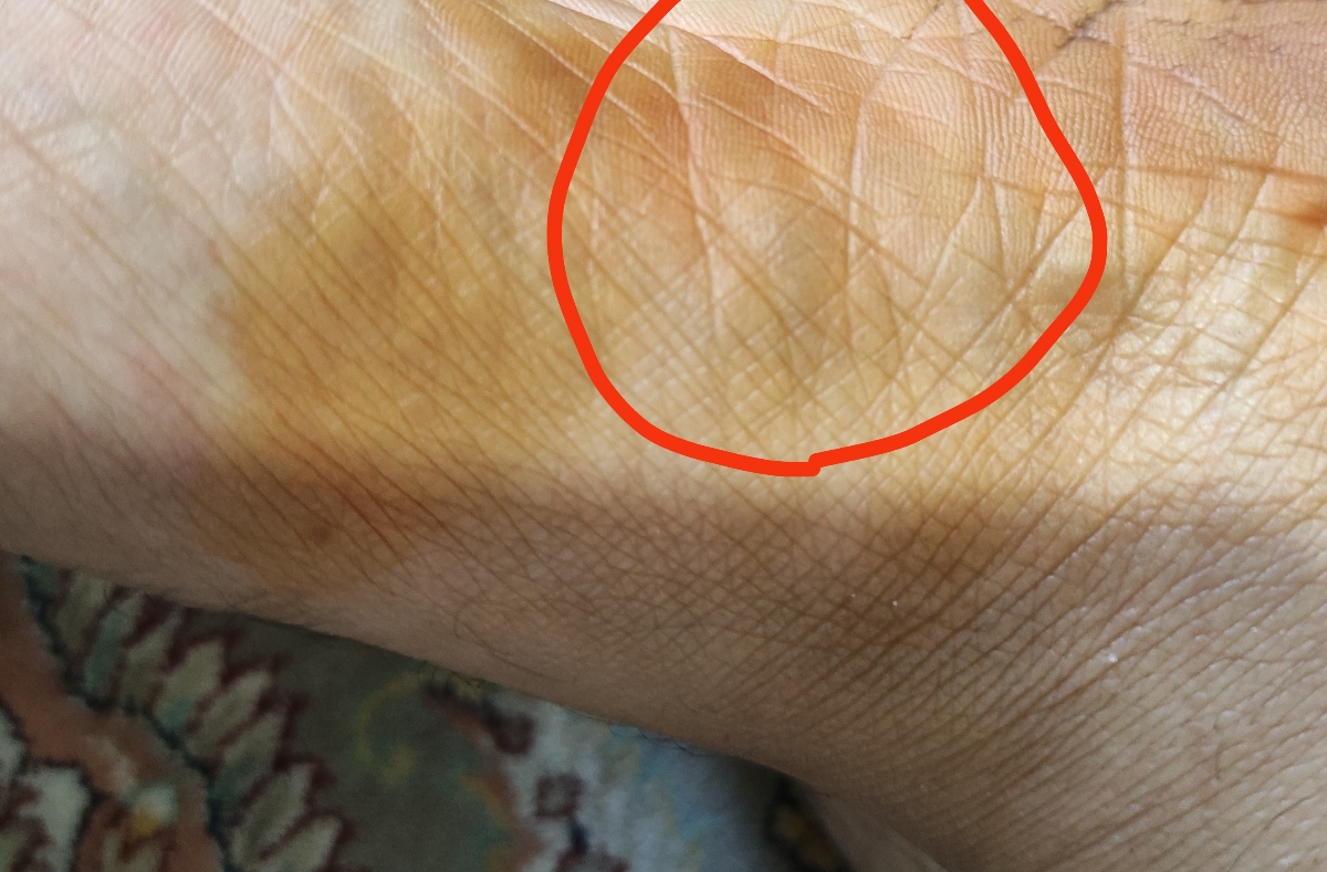 احساس درد کف پا از چیه