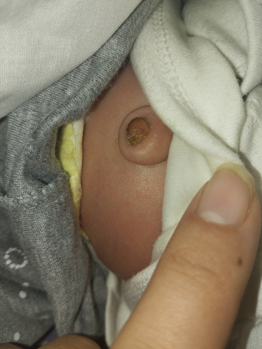 چرک کردن ناف نوزاد در اثر چیه و چکار کنم؟