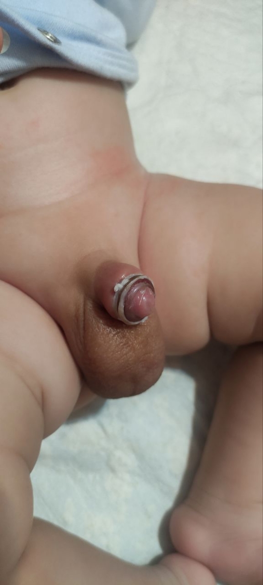 ورم ختنه نوزاد دوماهه