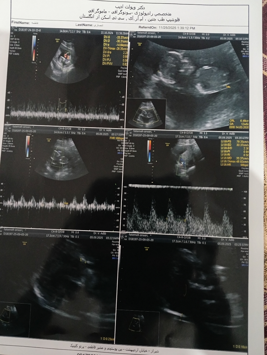 سلام خانم دکتر تفسیر سونو ان تی