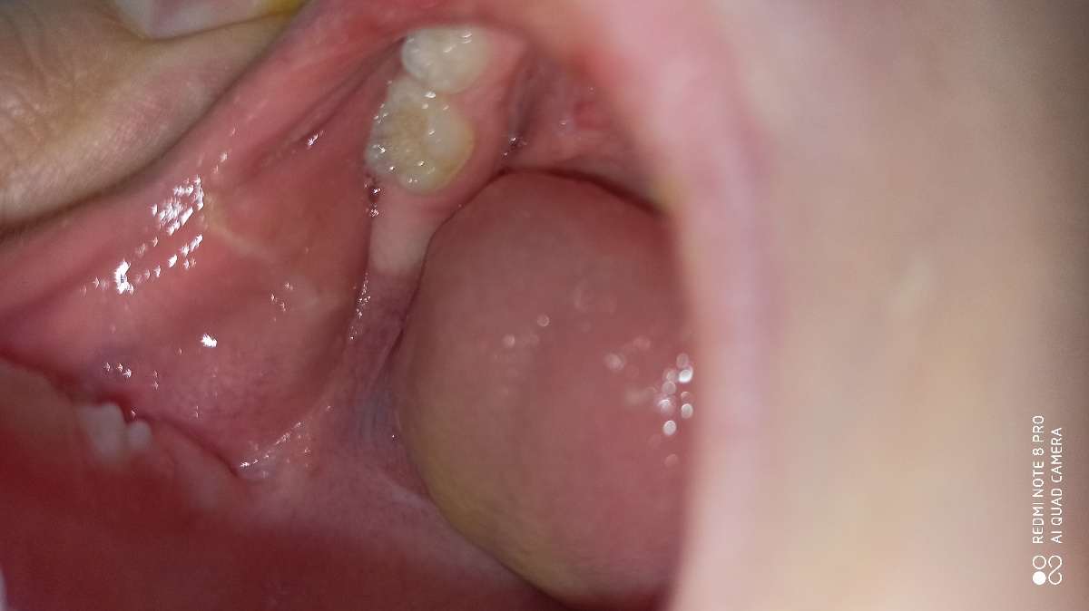 دونه های سفید چی هست دونه های سفید چی هست